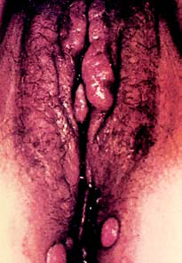 Warts - on female sex organ