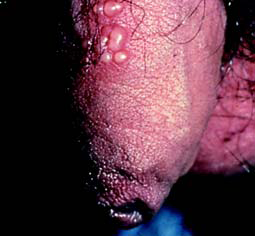 Herpes - sores on male sex organ