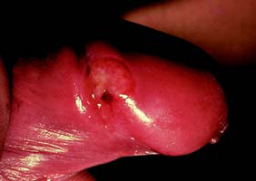 Syphilis - sore on male sex organ