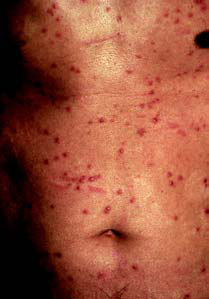 Syphilis - skin rash